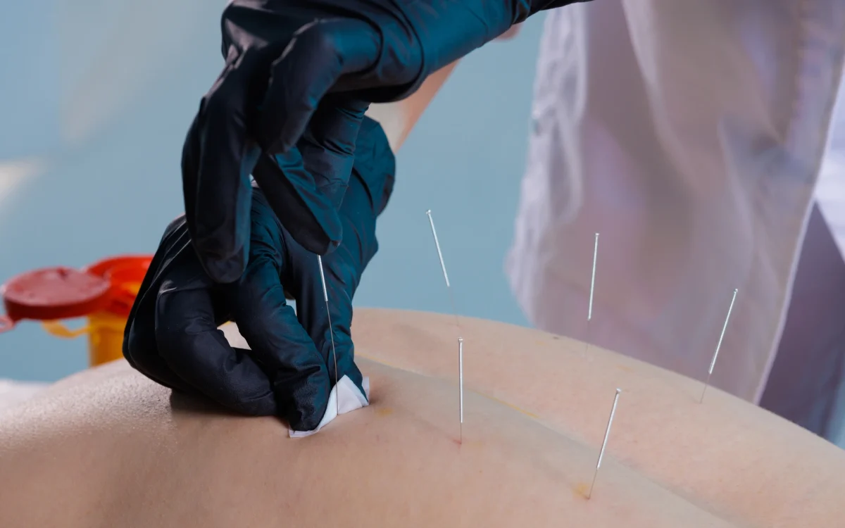 Unlocking Relief: The Effectiveness of Dry Needling 1 Dry Needling IMS Camrose