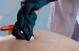 Unlocking Relief: The Effectiveness of Dry Needling